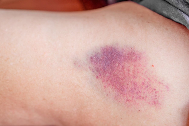 Tiêm cortisone có tác dụng gì? Ưu điểm và hạn chế khi tiêm cortisone 4