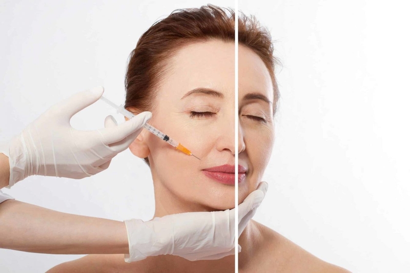 Tiêm filler có tự tan không là vấn đề mà nhiều người quan tâm.