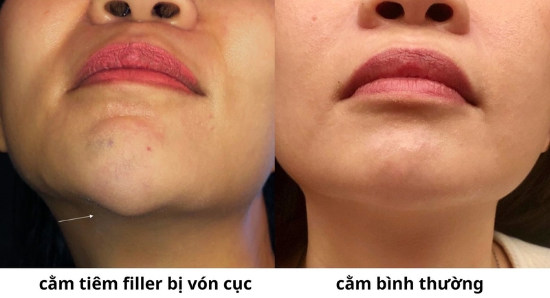 Tiêm filler bị vón cục: Nguyên nhân, triệu chứng, cách khắc phục 2