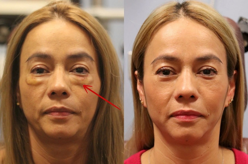 Tiêm filler bị vón cục: Nguyên nhân, triệu chứng, cách khắc phục 3