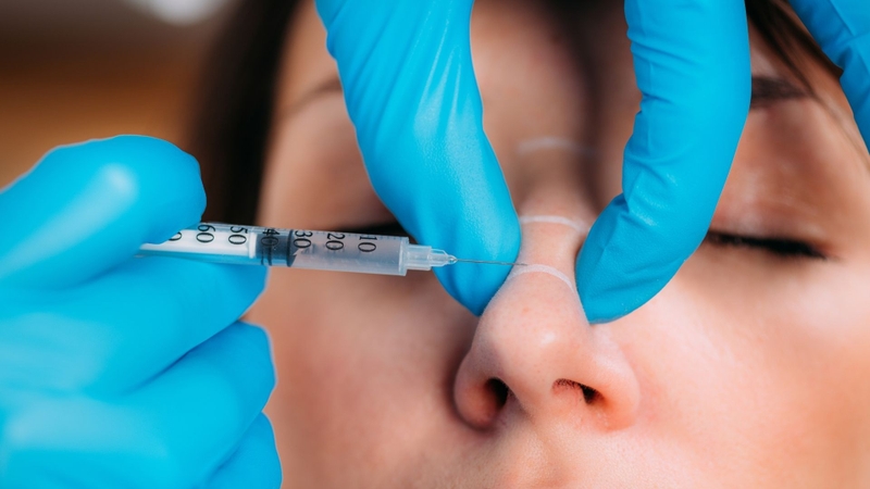 Hiệu quả của filler thường mang tính tạm thời