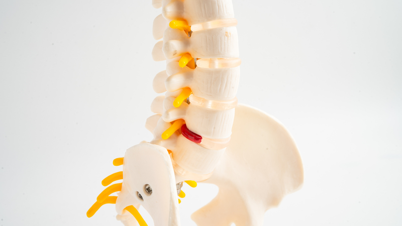 Tiêm màng cứng thoát vị đĩa đệm giúp giảm viêm, giảm sưng quanh rễ thần kinh đang bị chèn ép