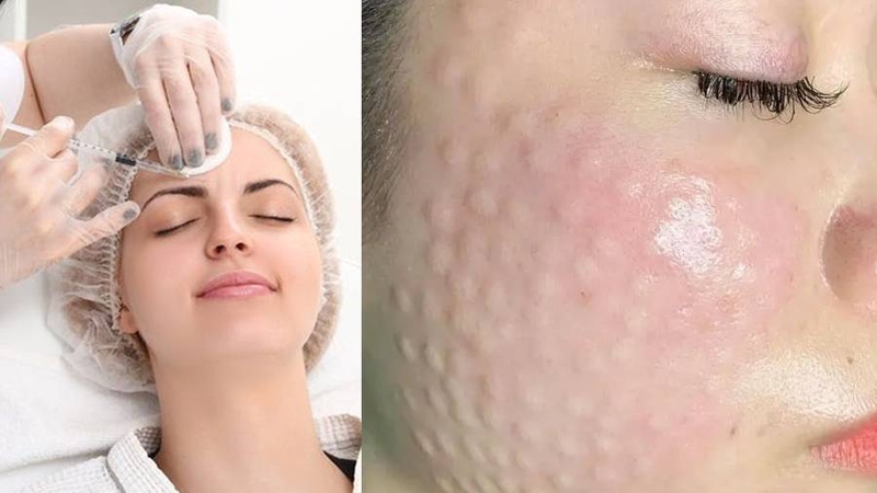 Tiêm meso bao lâu thì đẹp? Các yếu tố ảnh hưởng đến thời gian đẹp sau tiêm 1