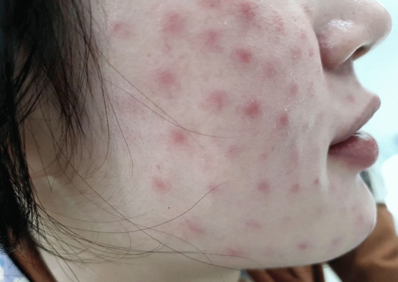 Tiêm meso là gì? Một số điều bạn cần lưu ý khi tiến hành tiêm meso 3