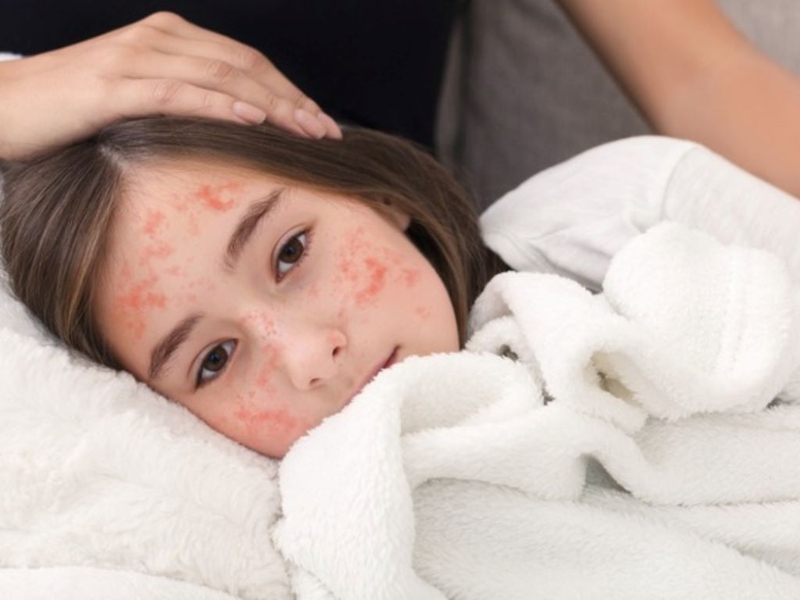 Tiêm mũi sởi bao nhiêu tiền? Những điều cần lưu ý khi tiêm sởi 1