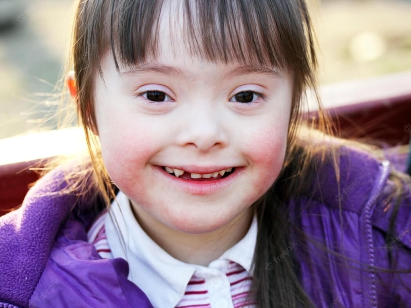 Một số nghiên cứu cho thấy người mắc hội chứng Down thường có đặc điểm vân tay bất thường