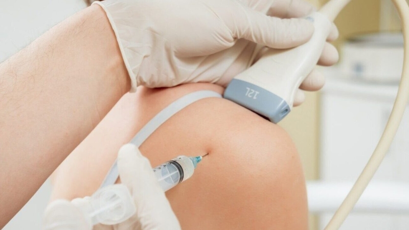 Tiêm phá đông khớp vai dưới: Quy trình thực hiện 3