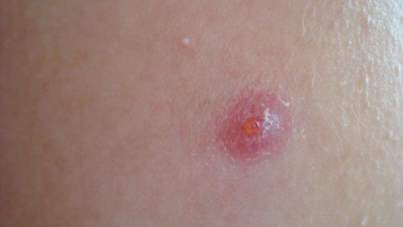 Tiêm phòng mũi lao không mưng mủ có sao không? Những điều ba mẹ cần lưu ý 2