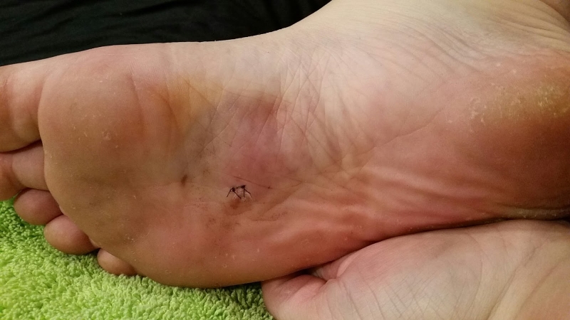 Tiêm phòng uốn ván quá liều có bị sao không 2