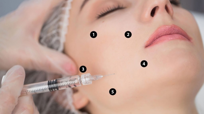 Tiêm profhilo là gì? Khi nào nên thực hiện? 1