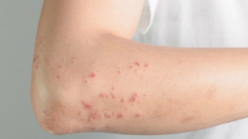 Tiêm sởi đơn xong có tiêm được sởi kép không? 1