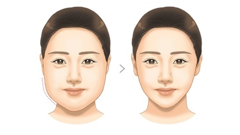 Tiêm tan mỡ mặt và tấn tần tật những điều cần biết 3