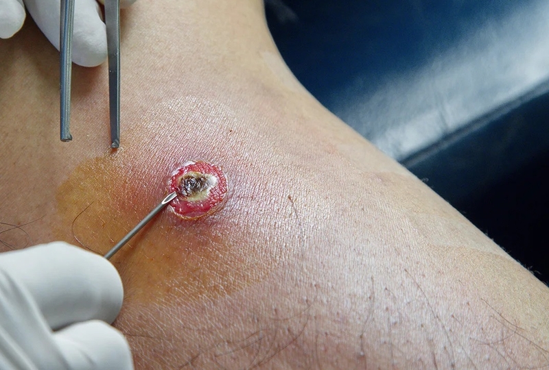 Cách xử lý sau khi tiêm thuốc bị áp xe phải làm sao? 2