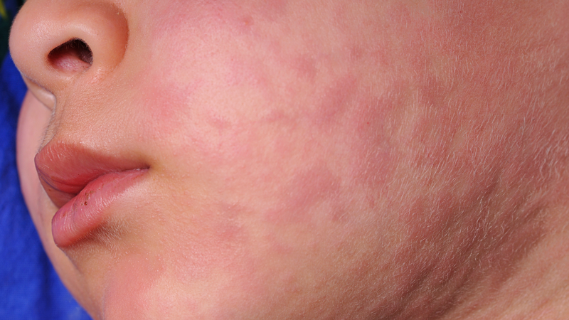 Tiêm vắc xin sởi ở đâu tại Quận 4? Địa chỉ và giá tiêm 1