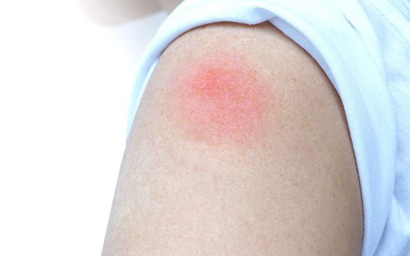 Tiêm vắc xin uốn ván bị sưng và ngứa nên xử lý như thế nào? -2