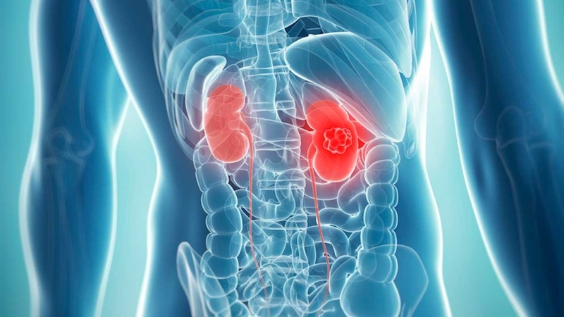 Tiên lượng ung thư thận: Những điều cần biết để chuẩn bị tốt hơn 2