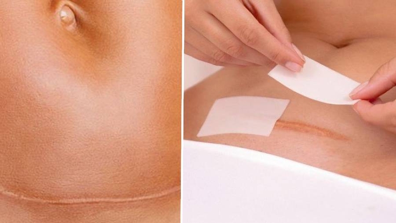 Mẹ nên vệ sinh vết mổ sạch để hạn chế nguy cơ nhiễm trùng, giúp vết mổ nhanh lành