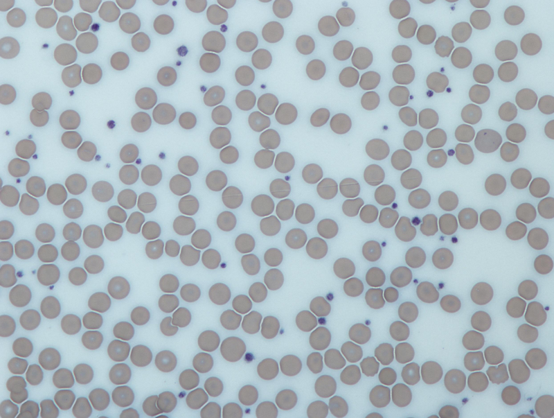 Tiểu cầu giảm bao nhiêu là nguy hiểm? Lưu ý gì để tránh biến chứng 1