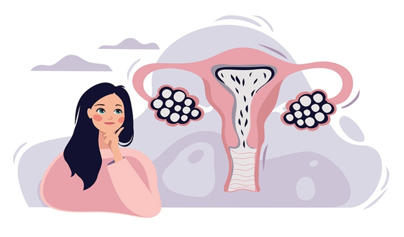 Tiêu chuẩn chẩn đoán buồng trứng đa nang: Cách nhận biết và hướng xử trí 1