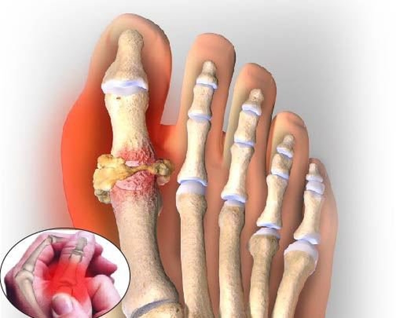 Tiêu chuẩn chẩn đoán Gout chính xác được sử dụng ngày nay