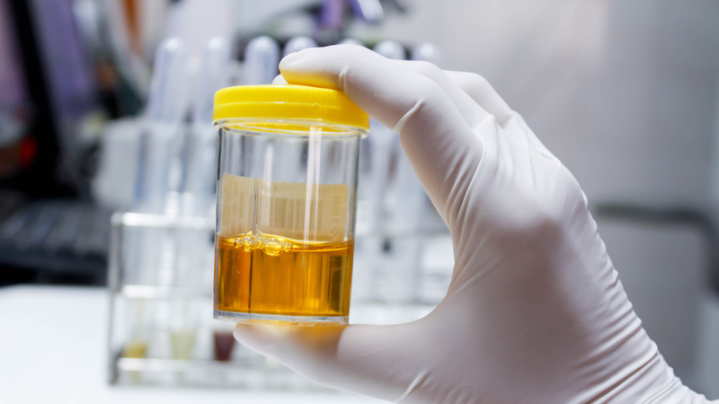 tieu-chuan-chan-doan-suy-than-man-va-anh-huong-cua-suy-than-man-toi-suc-khoe-tong-the 3