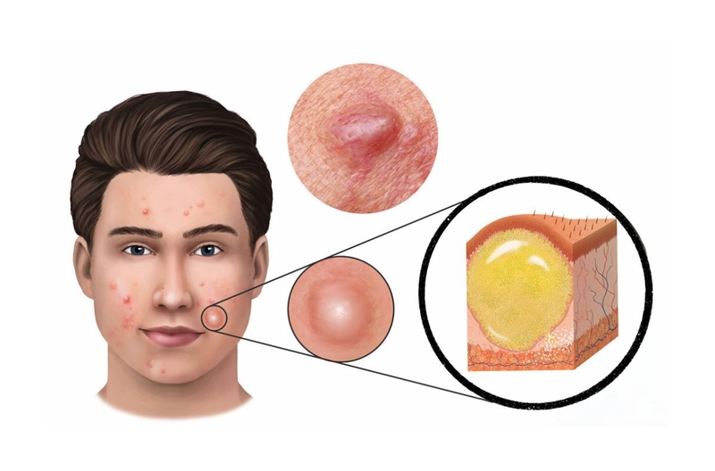 Các loại mụn viêm: Nguyên nhân và cách tiêu diệt các ổ mụn viêm 1