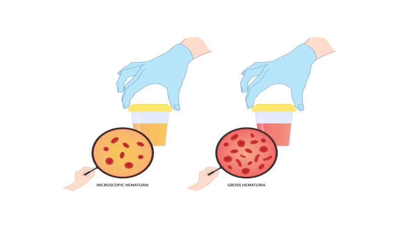 Tiểu máu vi thể: Nguyên nhân và cách điều trị 1