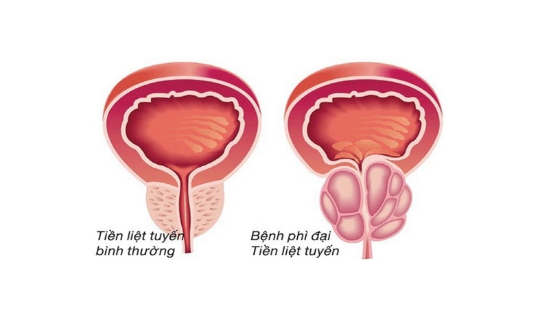 Tiểu máu vi thể: Nguyên nhân và cách điều trị 3