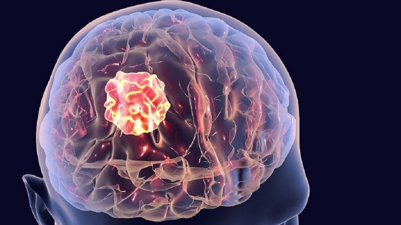 Tiêu xương sọ: Bệnh lý hiếm gặp và khó phát hiện 2.jpg