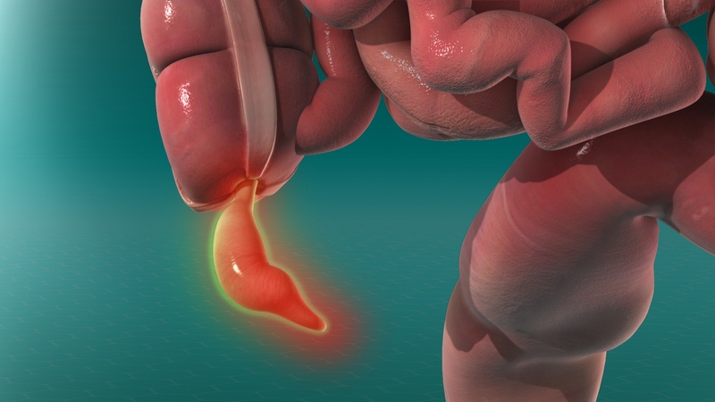 Tìm hiểu 3 vị trí mổ nội soi ruột thừa và quy trình thực hiện 1