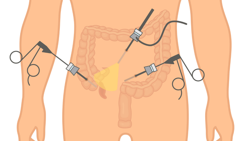 Tìm hiểu 3 vị trí mổ nội soi ruột thừa và quy trình thực hiện 4