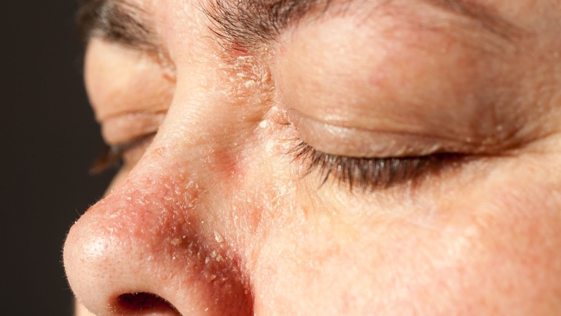 Tìm hiểu bệnh vảy nến da mặt và cách chữa trị hiệu quả 1