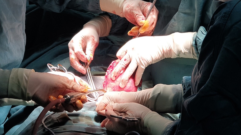 Tìm hiểu biến chứng u xơ tử cung thoái hóa 4