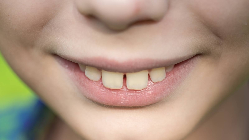 Tìm hiểu bọc răng sứ có hết hô không? 2