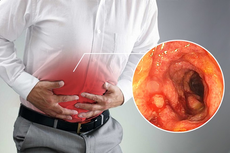 Bệnh lý viêm loét đại tràng có thể biến chứng nguy hiểm nếu không điều trị kịp thời