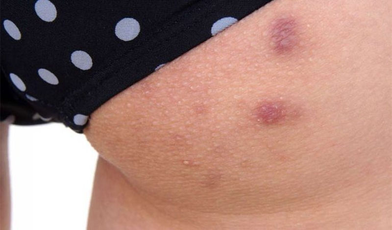 Mụn trở thành vết thâm khiến vùng da mông bị mất thẩm mỹ nghiêm trọng