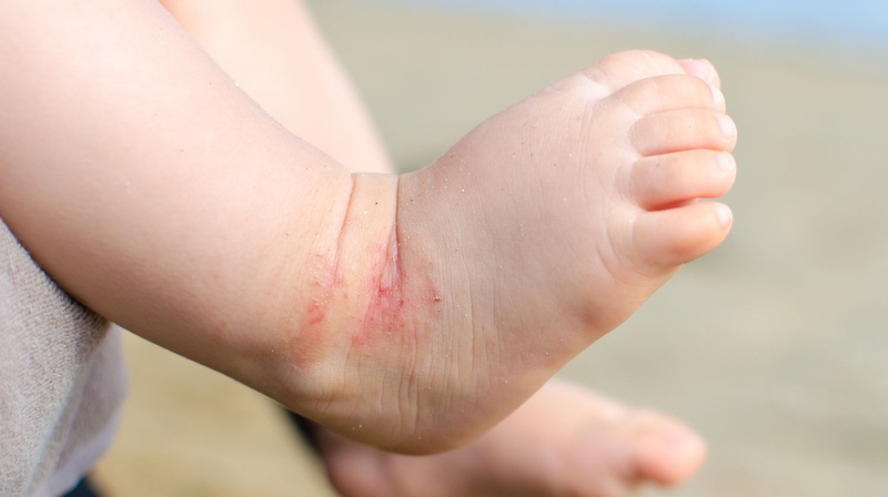 Tìm hiểu các dạng viêm da dị ứng ở trẻ nhỏ và cách phòng ngừa 2