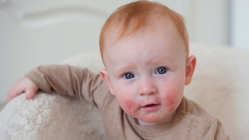 Tìm hiểu các dạng viêm da dị ứng ở trẻ nhỏ và cách phòng ngừa 1