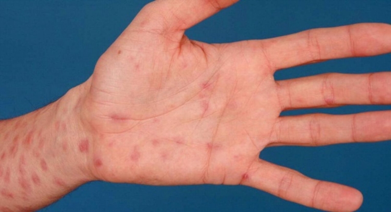 Tìm hiểu các giai đoạn bệnh giang mai 1