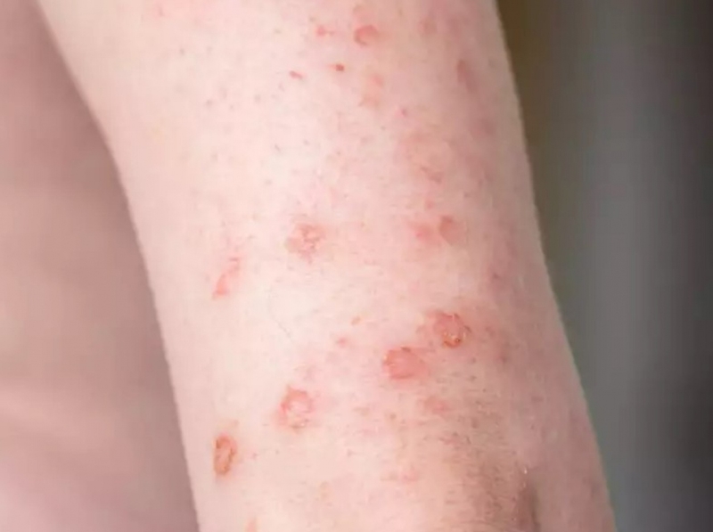 Tìm hiểu các giai đoạn bệnh giang mai 2