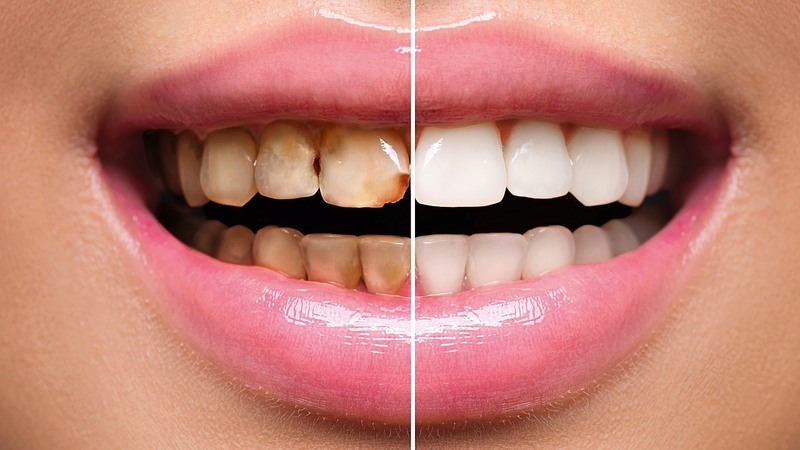 Tìm hiểu các kỹ thuật phục hình răng phổ biến hiện nay 1