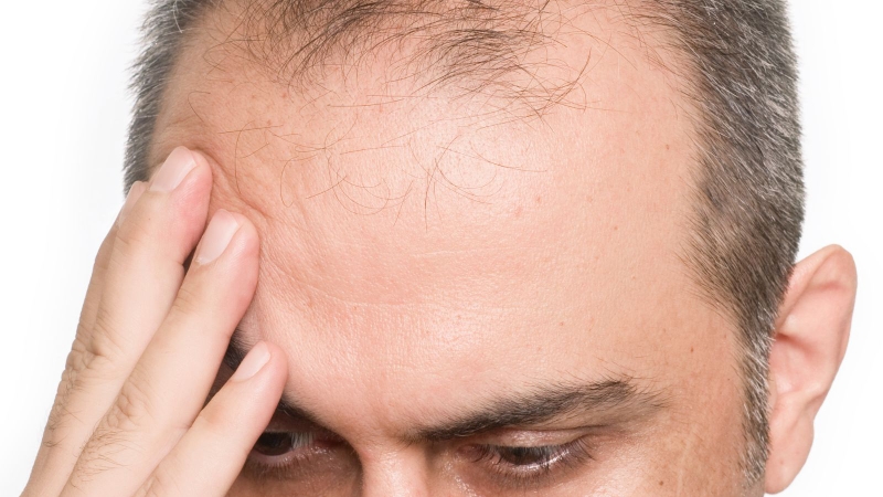 Cấy tóc chữ M: Giải pháp cho những ai bị hói vùng trán 1
