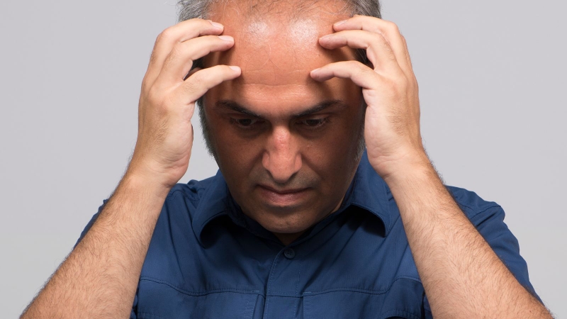 Cấy tóc chữ M: Giải pháp cho những ai bị hói vùng trán 2