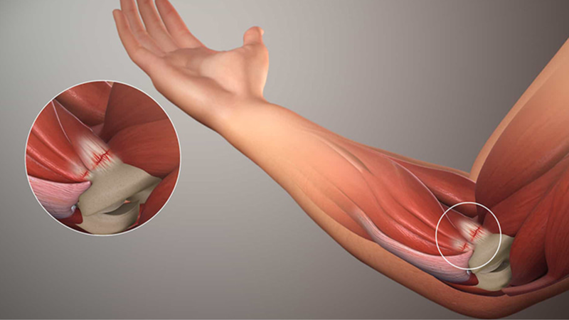 Tìm hiểu cấu tạo khuỷu tay và các vấn đề thường gặp ở khuỷu tay 3
