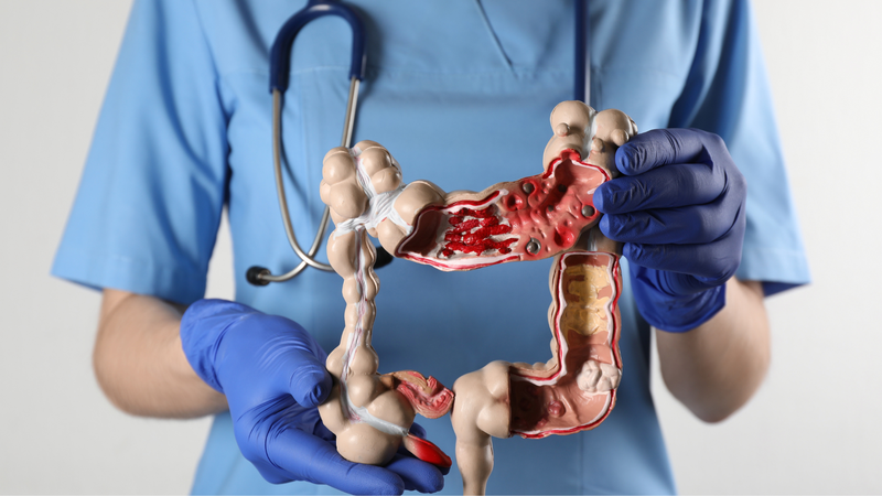 Nội soi đại tràng sigma không sinh thiết: Tìm hiểu thông tin chi tiết 3