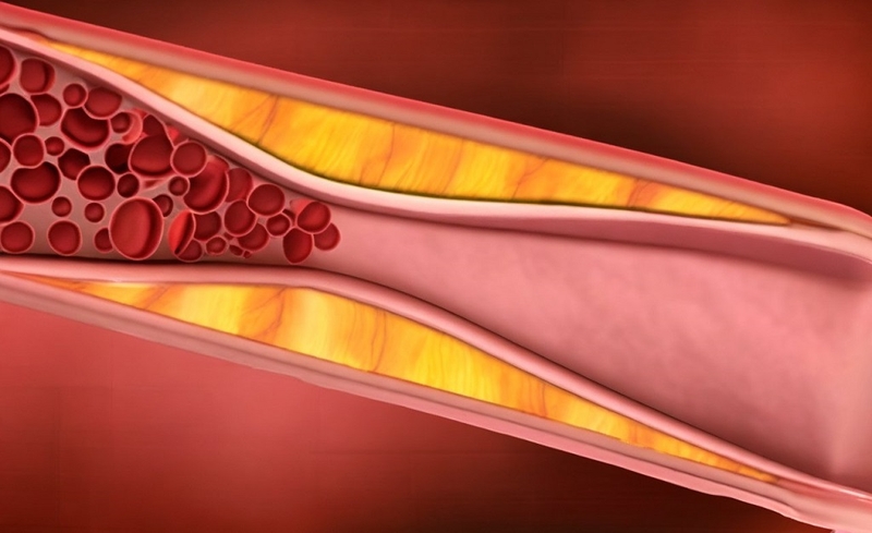 Tìm hiểu DAPT là gì? Quy định về thang điểm DAPT như thế nào? 2