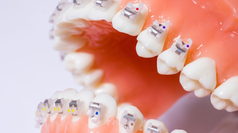 Tìm hiểu giá niềng răng mắc cài kim loại và các yếu tố ảnh hưởng đến chi phí 2
