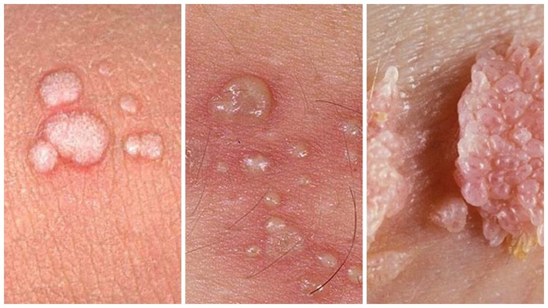 Tìm hiểu mụn cóc sinh dục có phải bệnh nguy hiểm không 1