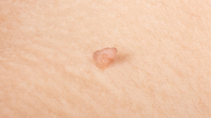 Tìm hiểu ngay 4 nguyên nhân khiến dương vật nổi mụn thịt! 1