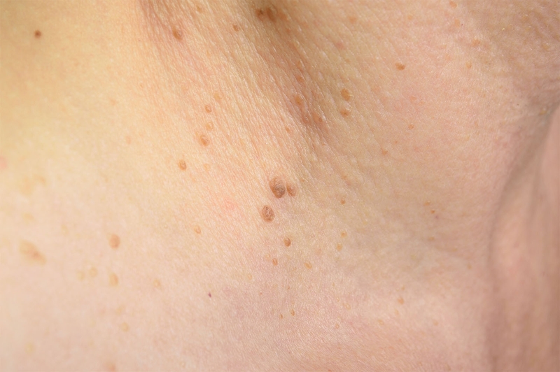 Tìm hiểu ngay 4 nguyên nhân khiến dương vật nổi mụn thịt! 3